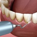 The Connection Between Gum Disease and Worsening Tooth Decay