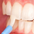 The Power of Fluoride Treatment in Preventing Tooth Decay