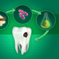 The Truth About Sugar and Tooth Decay: Expert Tips for Prevention