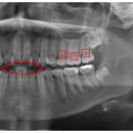 The Importance of Dental X-Rays in Detecting and Preventing Tooth Decay