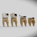 Preventing Tooth Decay: How Age Affects Your Risk and What You Can Do About It