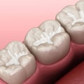 The Power of Dental Sealants: Preventing Tooth Decay