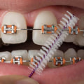 The Ultimate Guide to Keeping Your Teeth Clean with Braces
