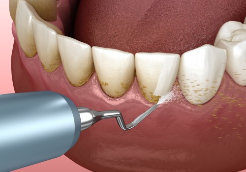 The Connection Between Gum Disease and Worsening Tooth Decay