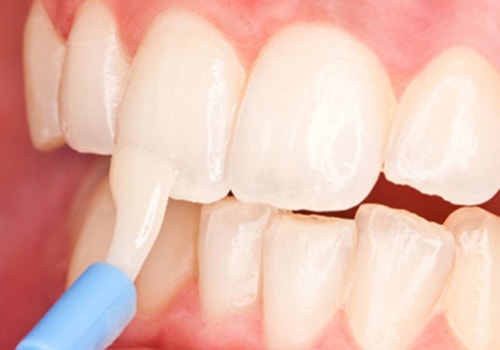 The Power of Fluoride Treatment in Preventing Tooth Decay