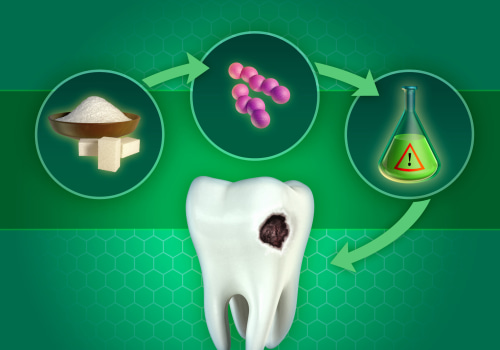 The Truth About Sugar and Tooth Decay: Expert Tips for Prevention