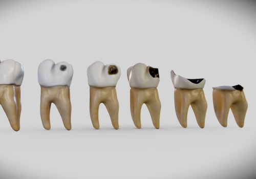 Preventing Tooth Decay: How Age Affects Your Risk and What You Can Do About It
