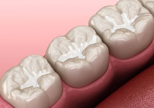 The Power of Dental Sealants: Preventing Tooth Decay