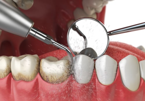 The Importance of Regular Dental Cleanings for Preventing Tooth Decay