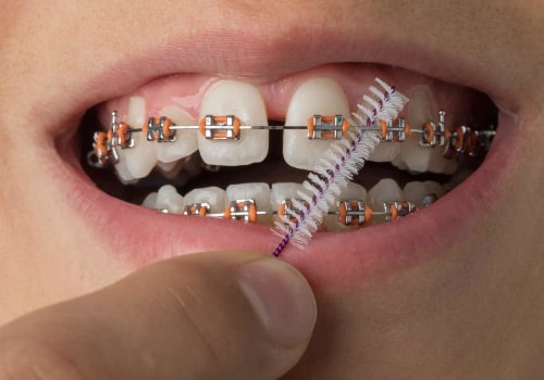 The Ultimate Guide to Keeping Your Teeth Clean with Braces