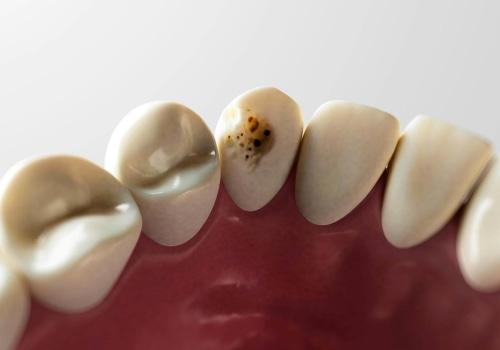 The Genetics Behind Tooth Decay and How to Prevent It